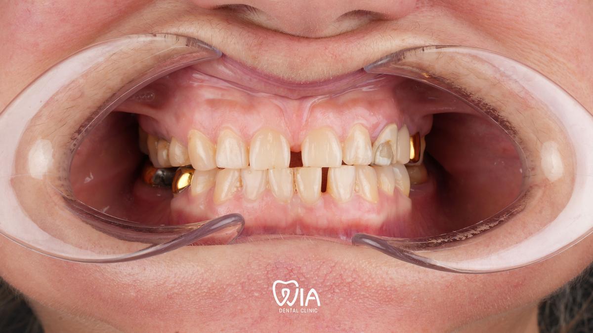 After — Dental Implants