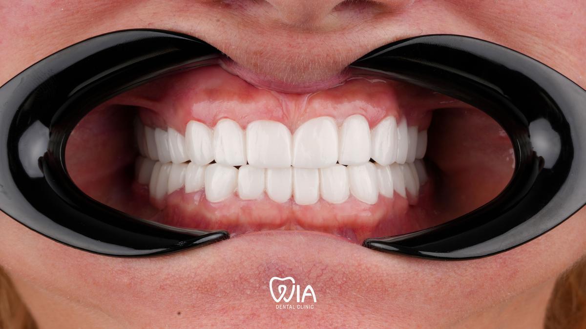 Before — Dental Implants