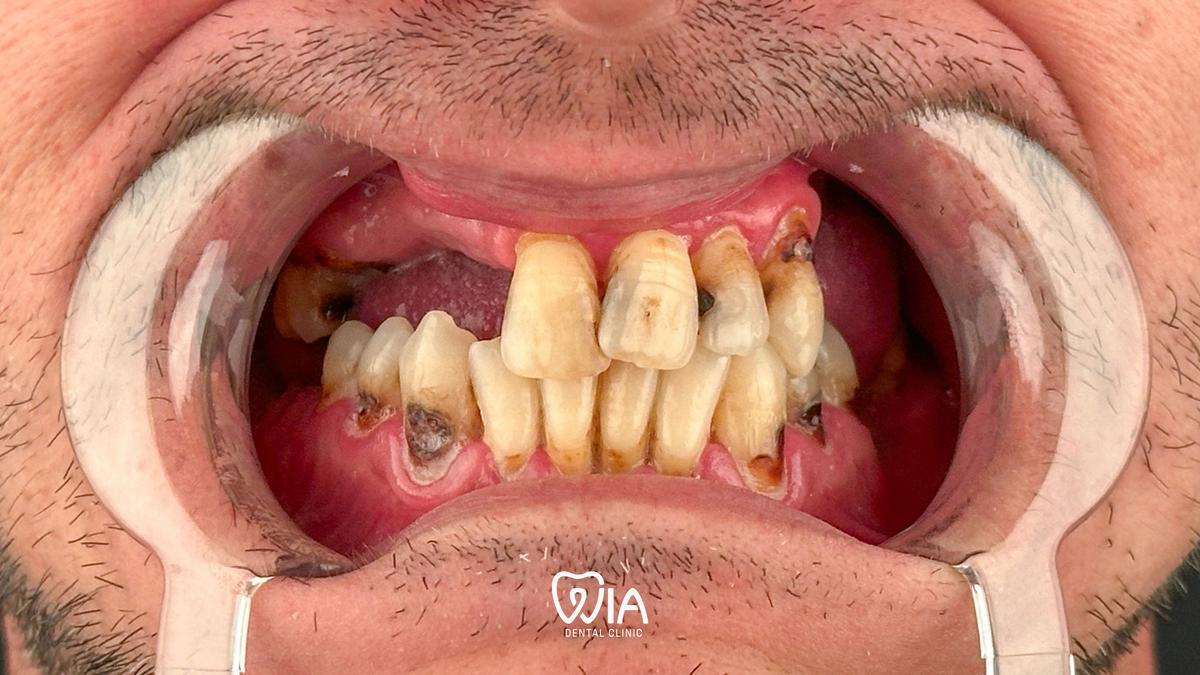 Before — Complex Treatment